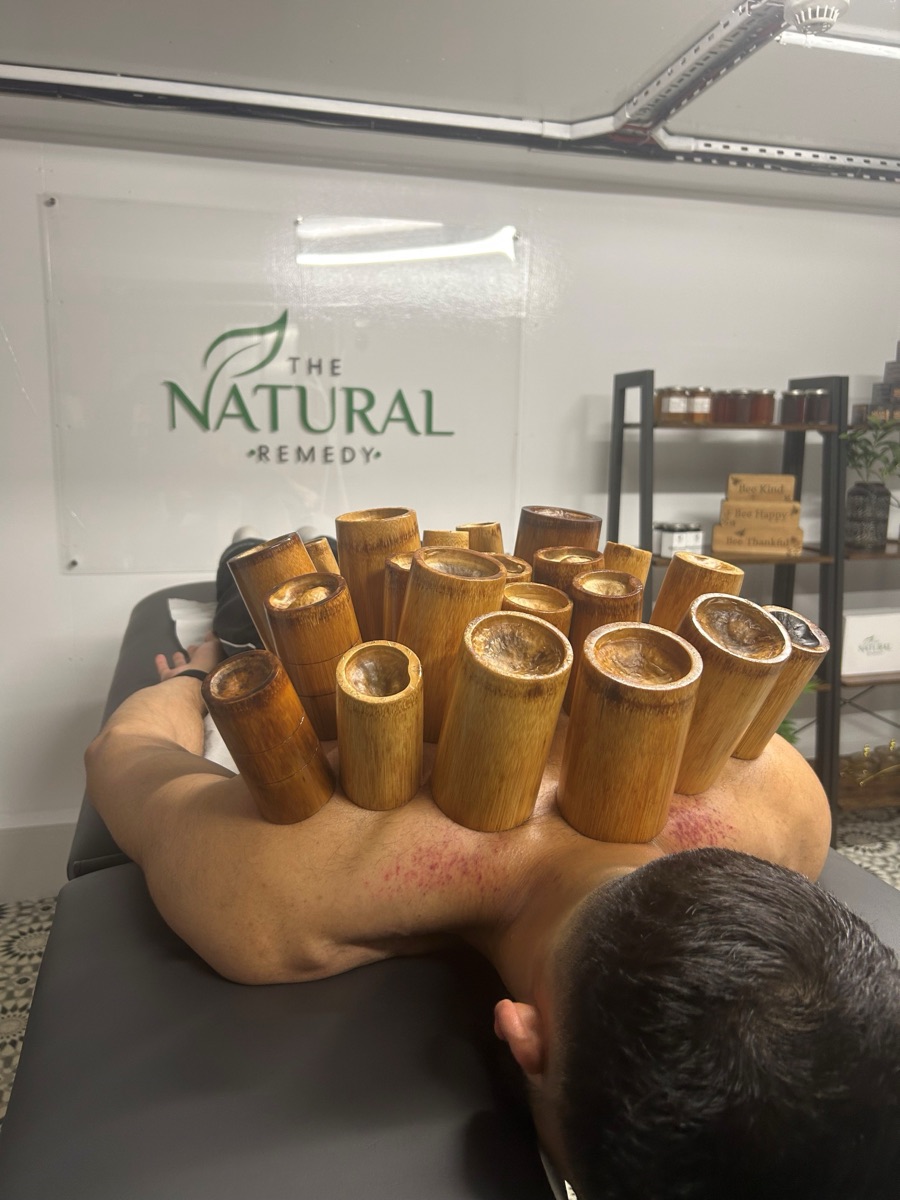 Hijama therapy